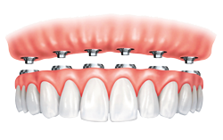 Dental Implant - Solutions for Missing Teeth