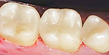 After Dental Inlay