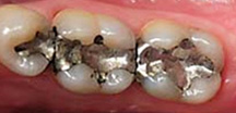 Before Dental Inlay