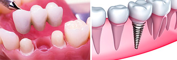 Dental Implants vs. Dental Bridges