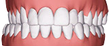 Invisalign - Designs For Dental Health