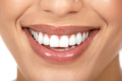 Instant straight, beautiful teeth