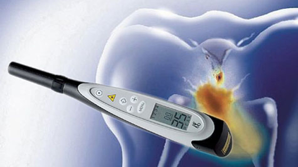DiagnoDent Early Cavity Detection