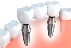 Dental Implant - Solutions for Missing Teeth