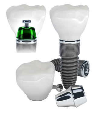 Dental Implant