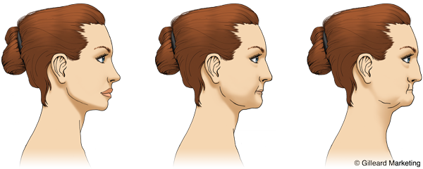 Jawbone Reduction - Benefits of Dental Implants