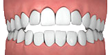 Invisalign - Designs For Dental Health