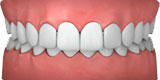Invisalign - Designs For Dental Health