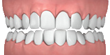Invisalign - Designs For Dental Health