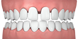 Invisalign - Designs For Dental Health