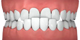 Invisalign - Designs For Dental Health